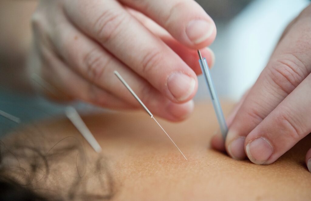 A woman getting acupuncture on her back.