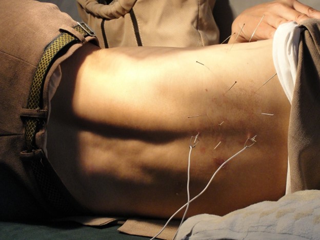 A person laying on a bed with acupuncture needles.