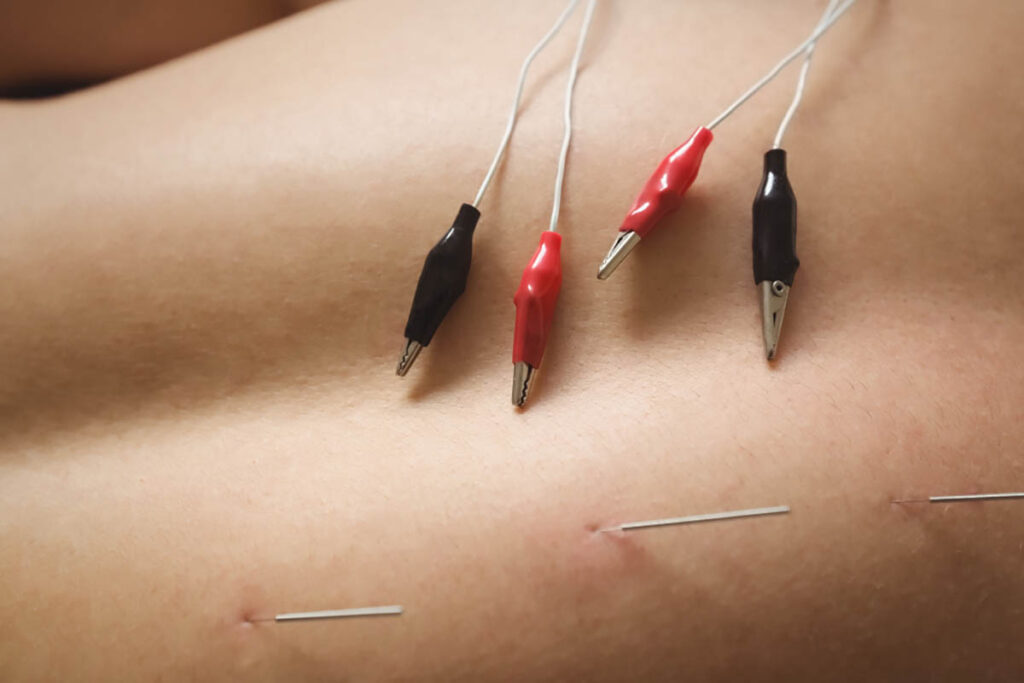 Dry needling: An innovative tool in treating pelvic-related conditions