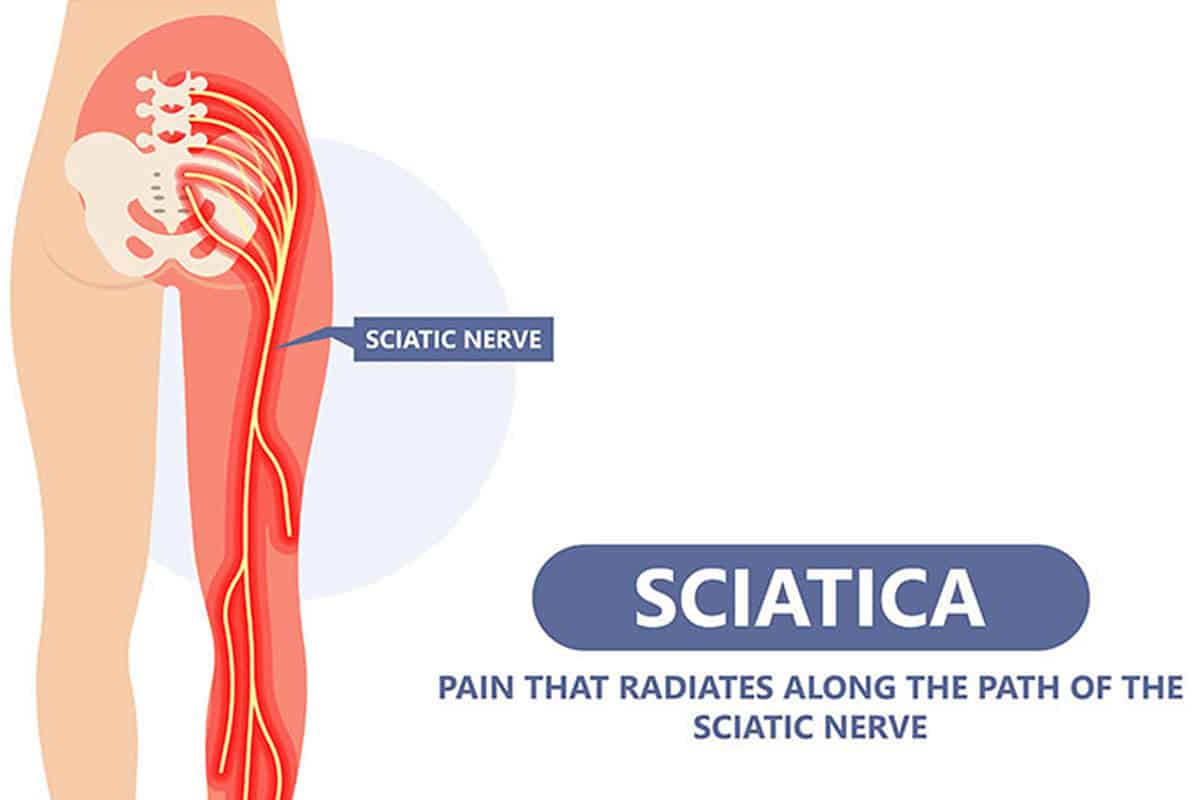 Can Sciatica Cause Hip Pain What To Know Can Sciatica Cause Hip Pain What To Know